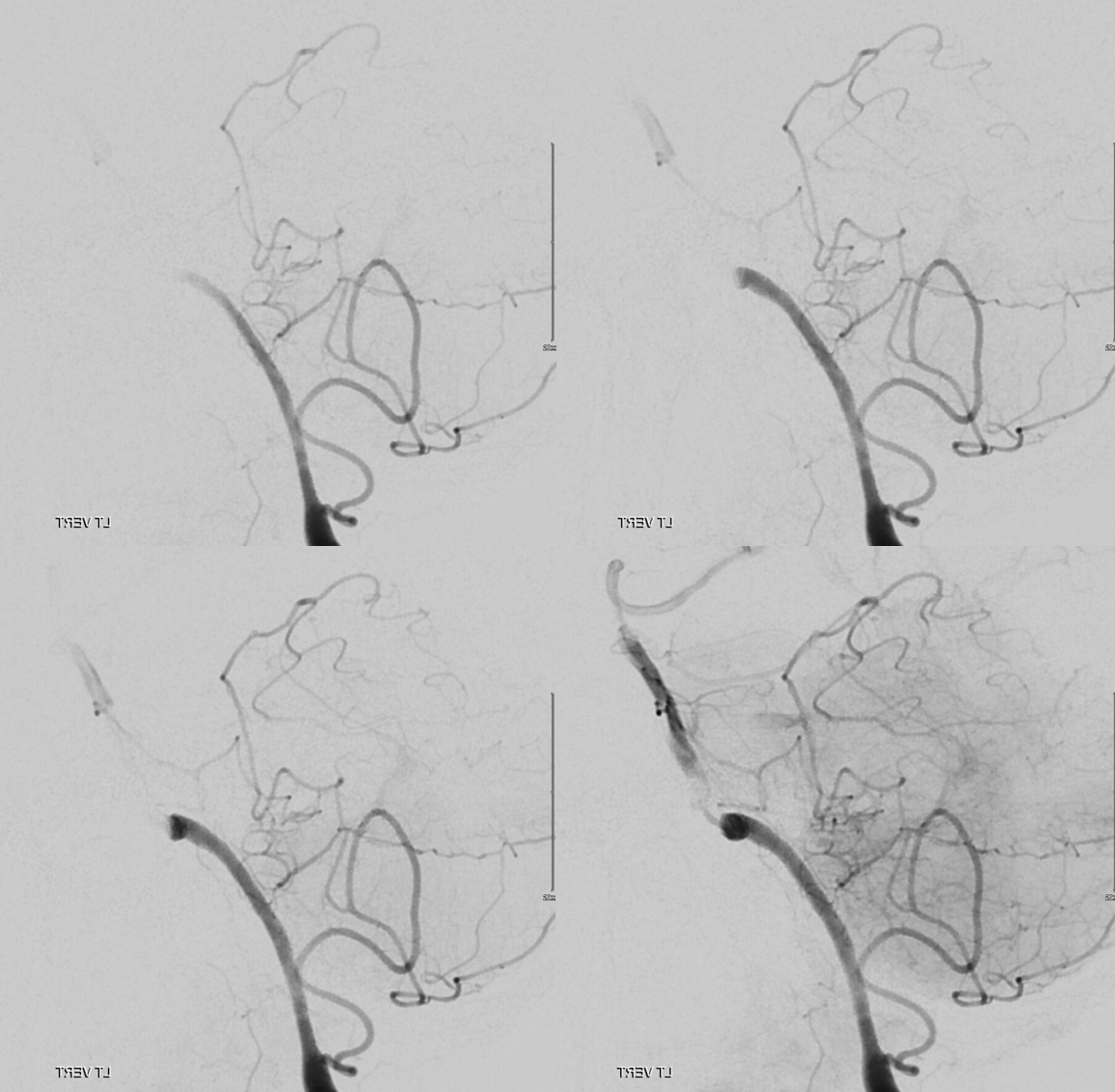 Basilar Artery Stenting Acute Stroke Neuroangio Org