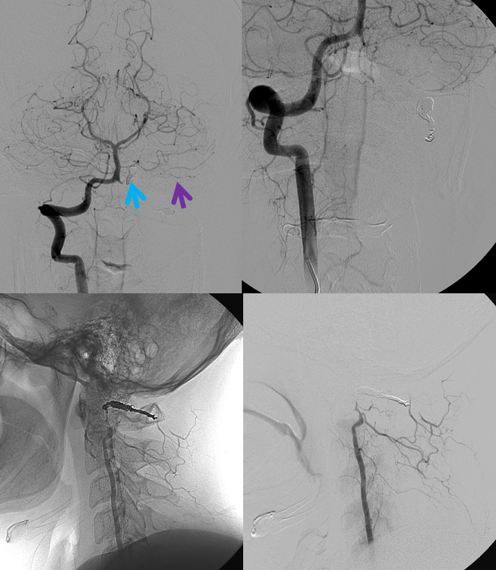 Lateral Spinal Aneurysm