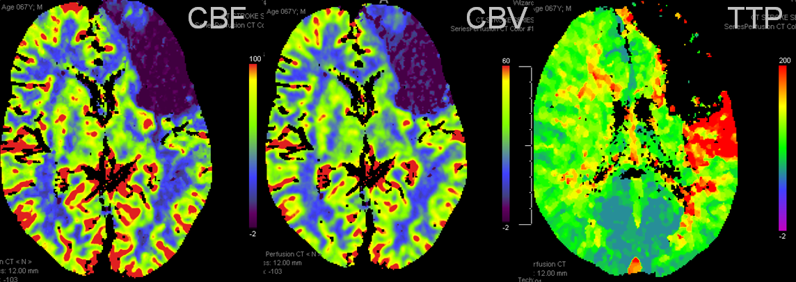 ct-perfusion-scan-ct-scan-machine