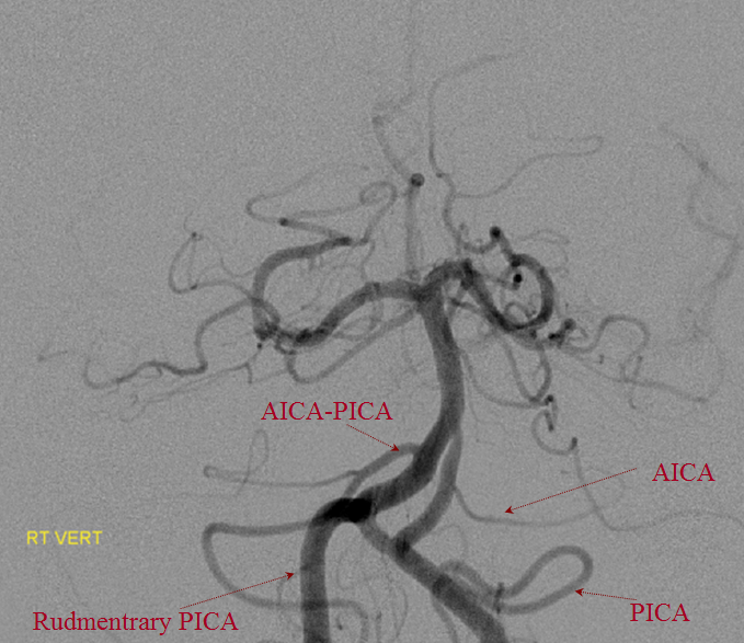 aica vs pica syndrome