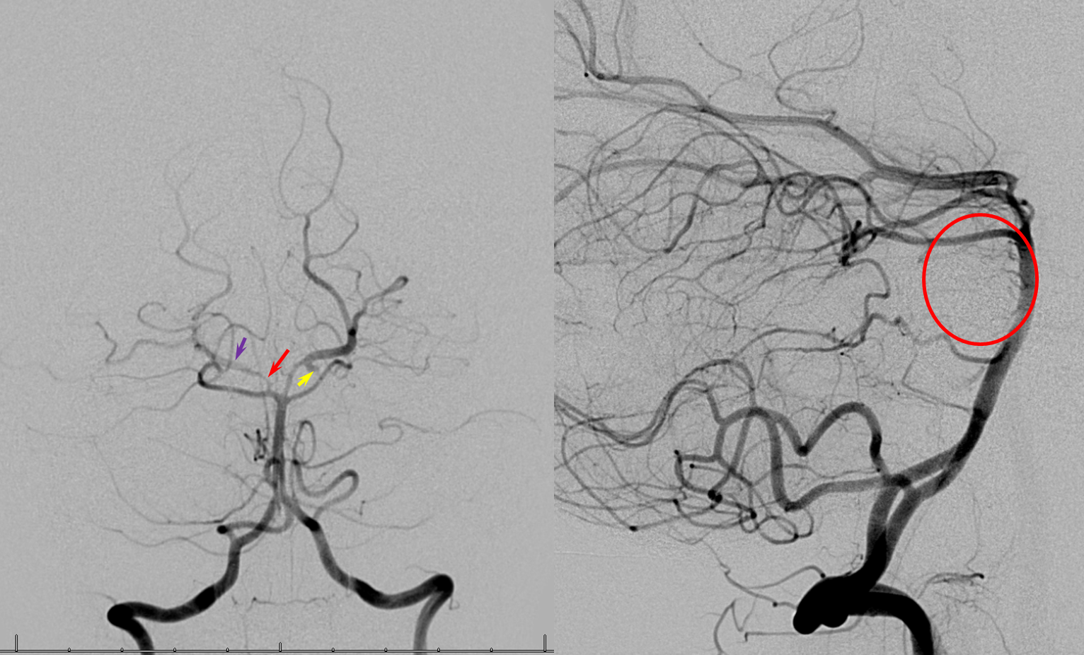 pica artery syndrome