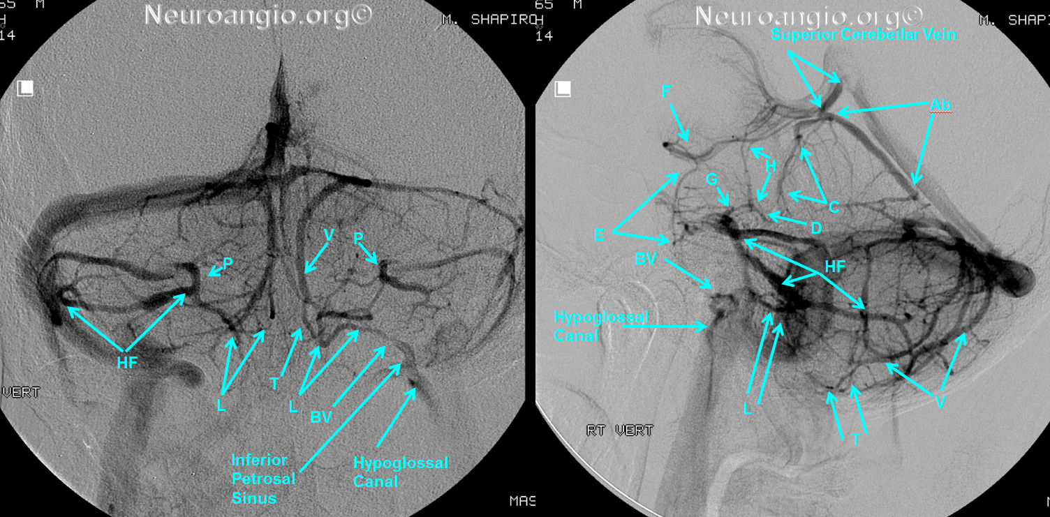 http://www.neuroangio.org/wp-content/uploads/Venous/Posterior_Fossa_Veins/V_bridging_veins_horizontal_fissure_labels.png