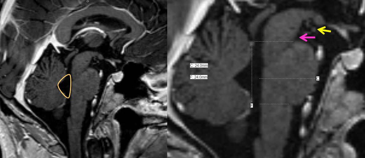 4th ventricle MRI