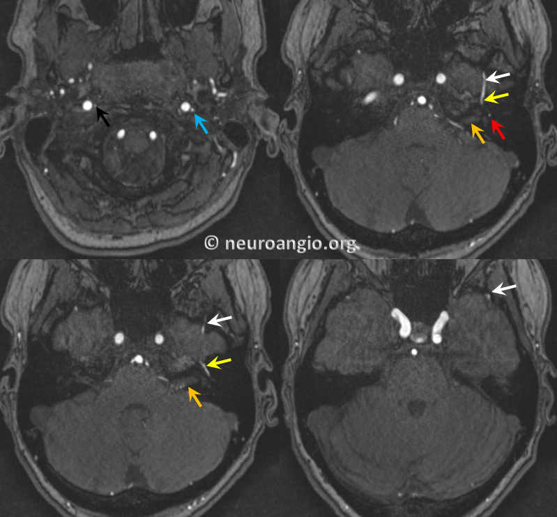 https://neuroangio.org/wp-content/uploads/AP/AP_Stapedial_Artery_MRI_2.png