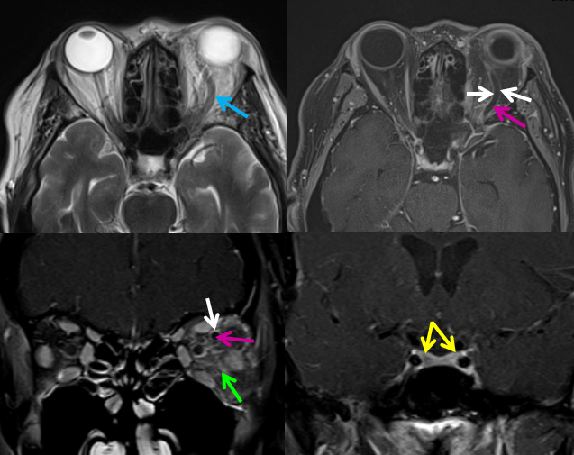 https://neuroangio.org/wp-content/uploads/Archives/Archives_Cavernous_Thrombophlebitis_1.png