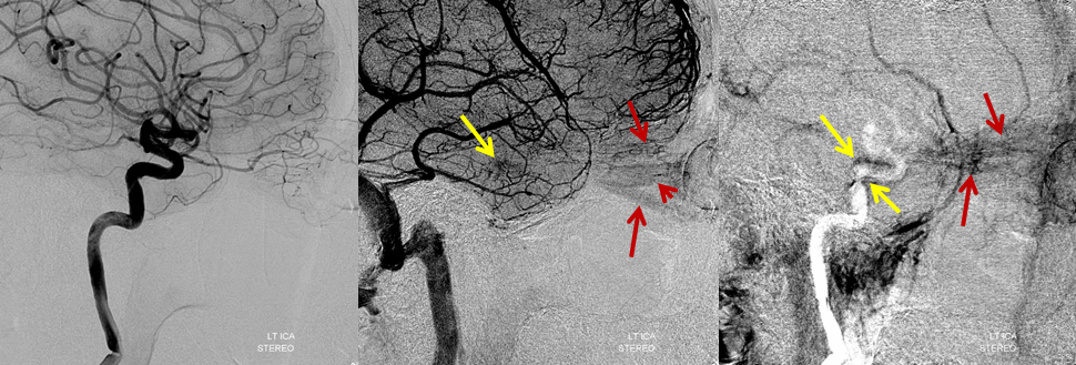 https://neuroangio.org/wp-content/uploads/Archives/Archives_Cavernous_Thrombophlebitis_2.png