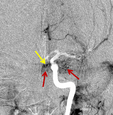 https://neuroangio.org/wp-content/uploads/Archives/Archives_Cavernous_Thrombophlebitis_3.png