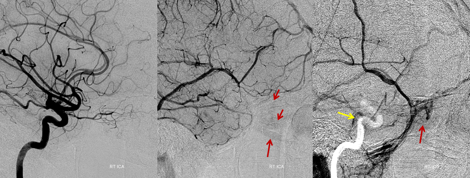 https://neuroangio.org/wp-content/uploads/Archives/Archives_Cavernous_Thrombophlebitis_5.png