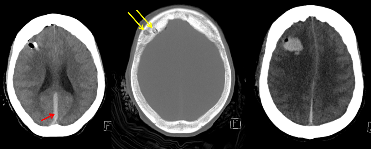 MMA extravasation CT 1