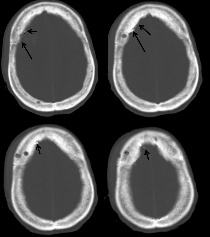 MMA extravasation CT 2