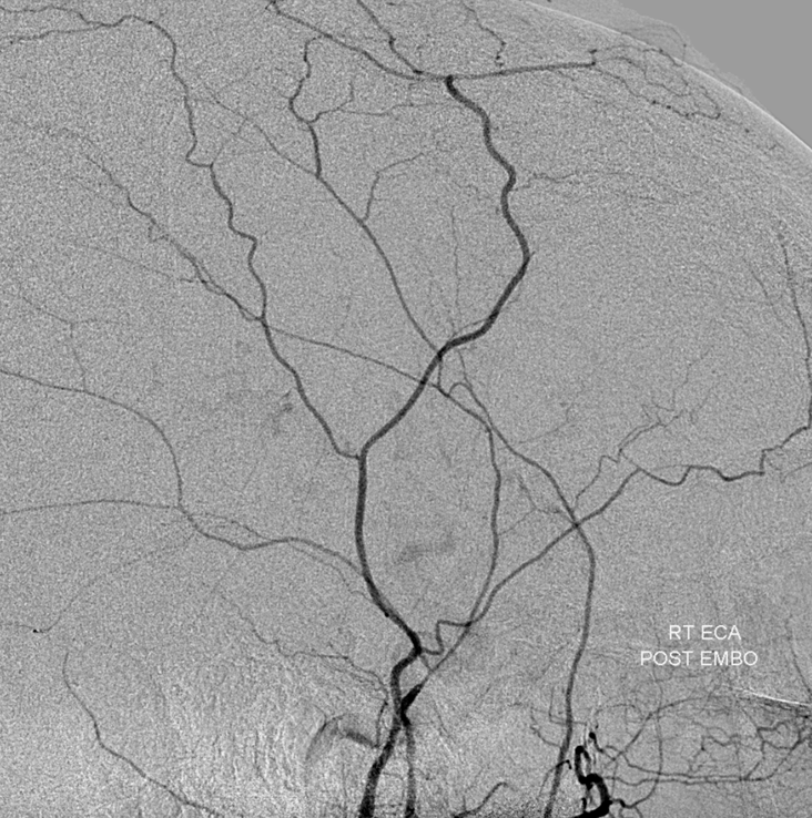 Post embolization ECA injection