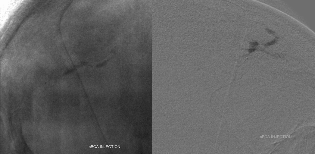 Post embolization ECA injection