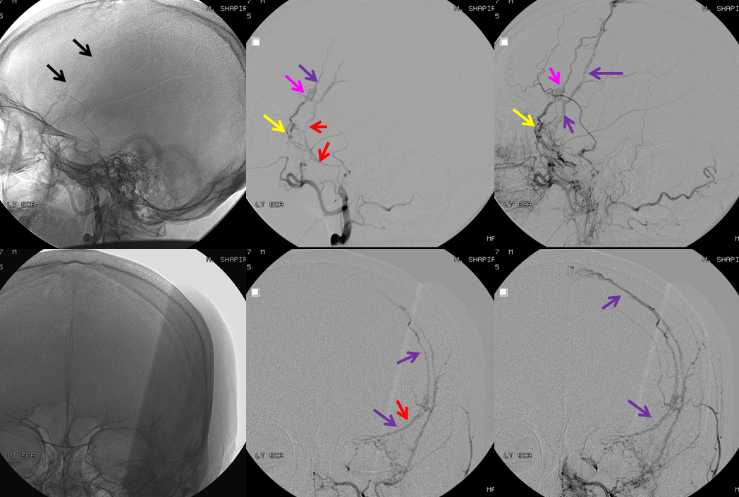 https://neuroangio.org/wp-content/uploads/Archives/Archives_MMA_fistula_3.png