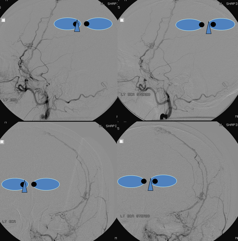 https://neuroangio.org/wp-content/uploads/Archives/Archives_MMA_fistula_4.png