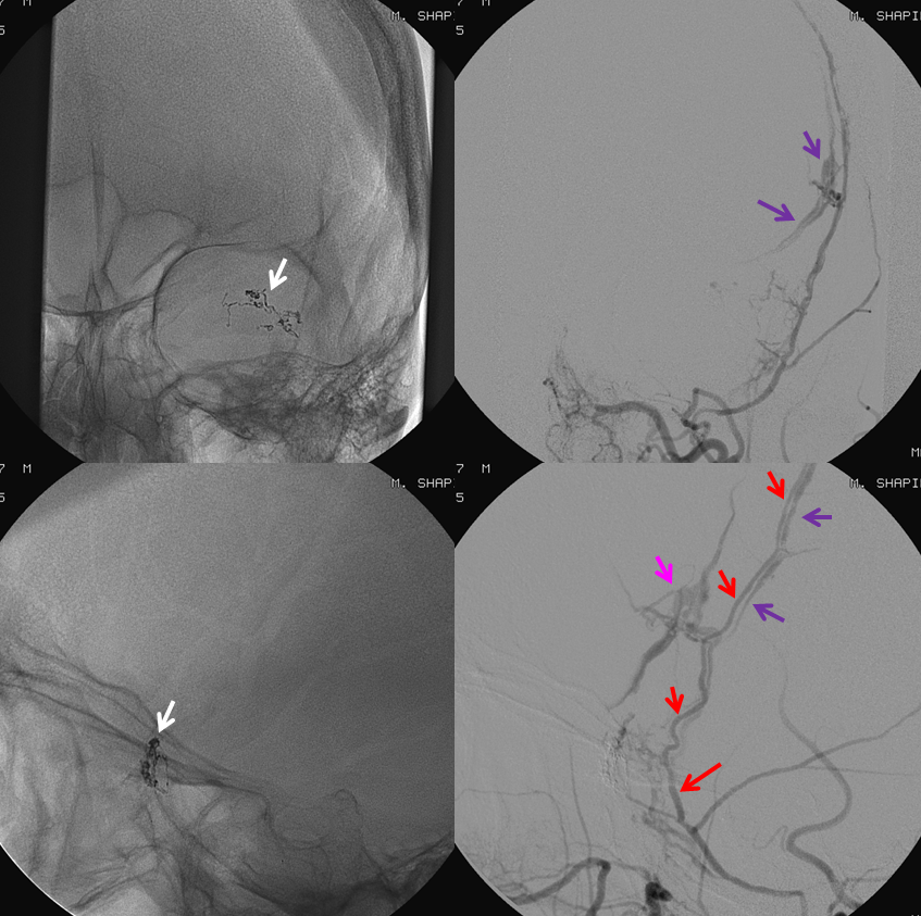 https://neuroangio.org/wp-content/uploads/Archives/Archives_MMA_fistula_6.png