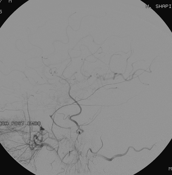 https://neuroangio.org/wp-content/uploads/Archives/Archives_MMA_fistula_7.png