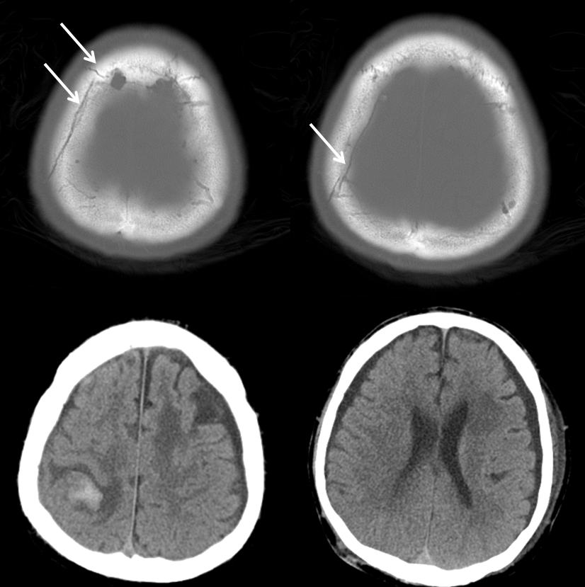 Traumatic MMA fistula CT