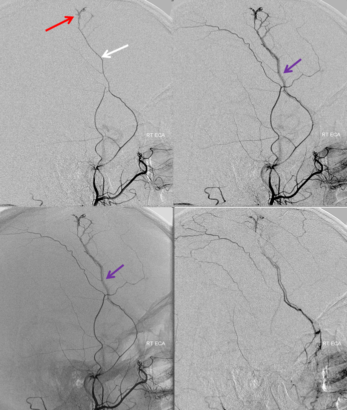 Traumatic MMA fistula angio