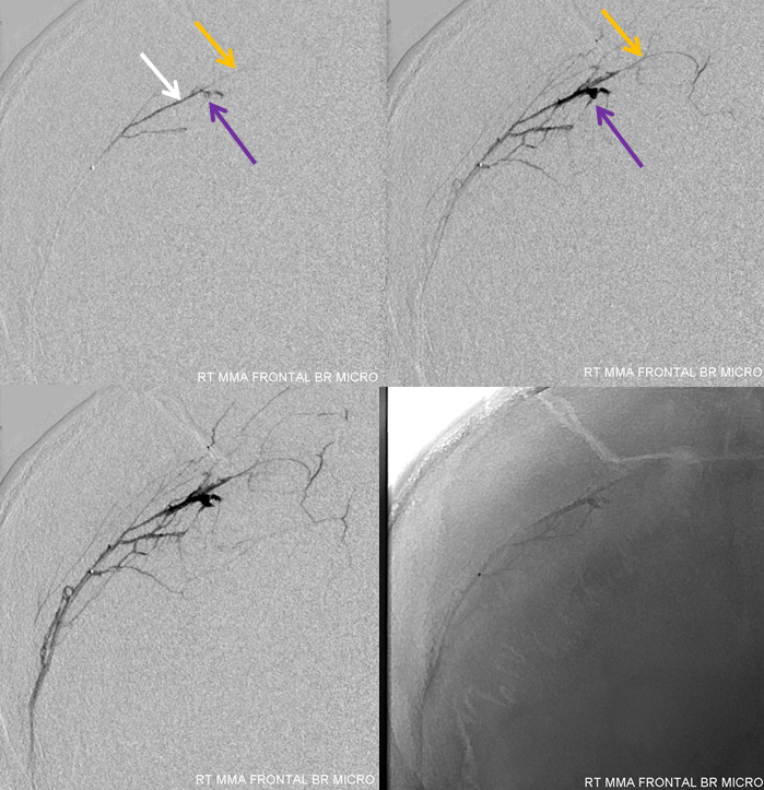 Traumatic MMA fistula angio micro