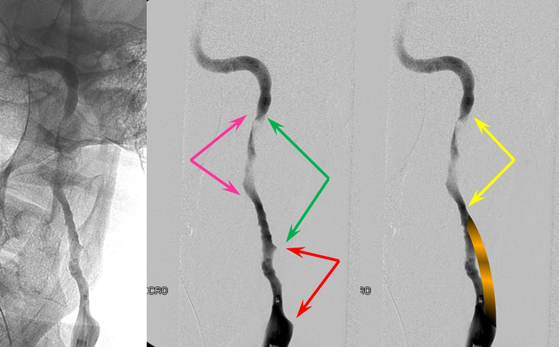 https://neuroangio.org/wp-content/uploads/Archives/Archives_dissection_false_lumen_3.png