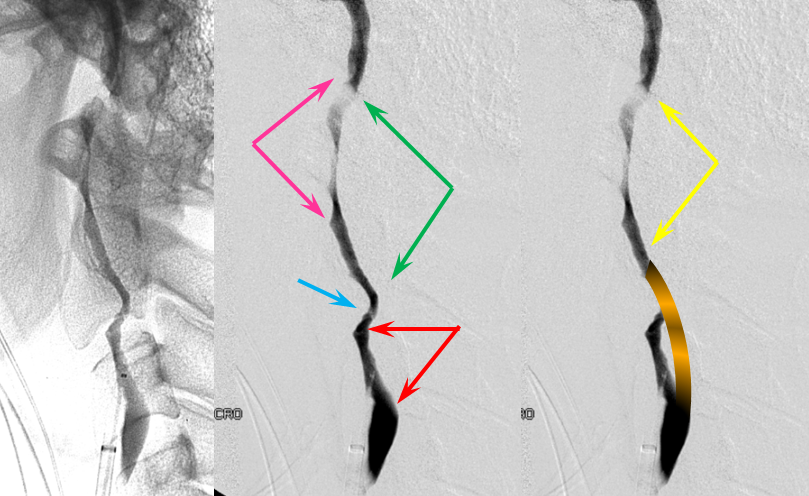 https://neuroangio.org/wp-content/uploads/Archives/Archives_dissection_false_lumen_4.png