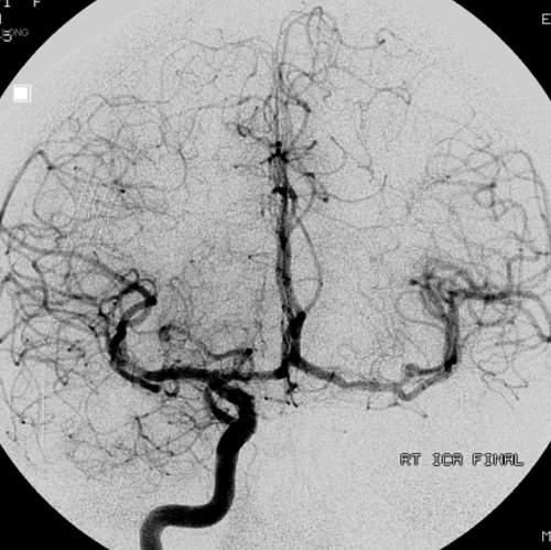 https://neuroangio.org/wp-content/uploads/Archives/Archives_dissection_false_lumen_5.png