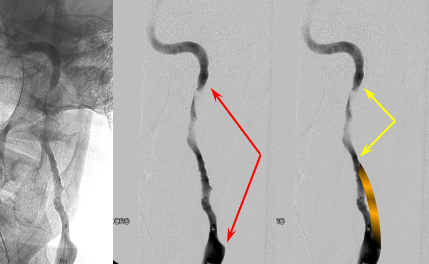 https://neuroangio.org/wp-content/uploads/Archives/Archives_dissection_false_lumen_7.png