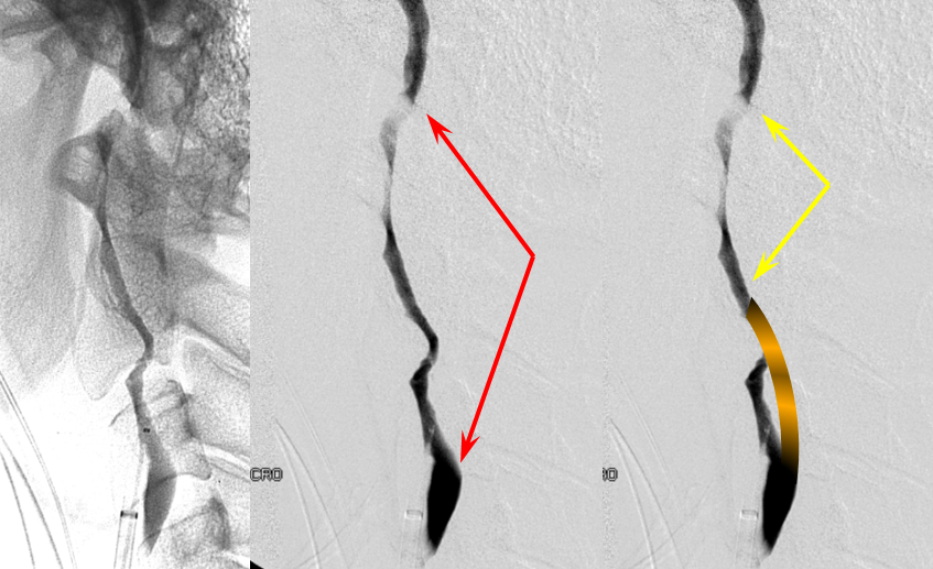 https://neuroangio.org/wp-content/uploads/Archives/Archives_dissection_false_lumen_8.png