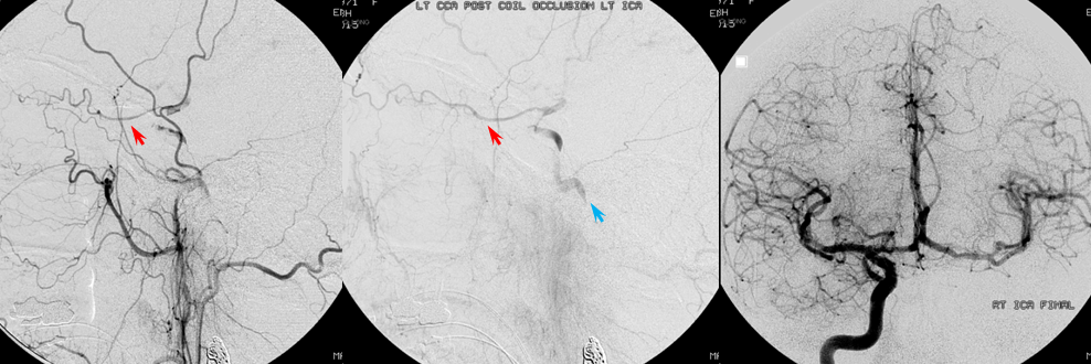 https://neuroangio.org/wp-content/uploads/Archives/Archives_dissection_false_lumen_9.png