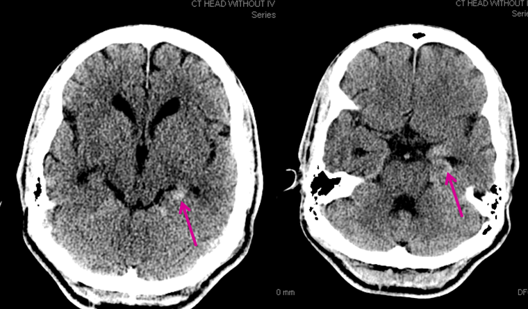 Encephalitis CT