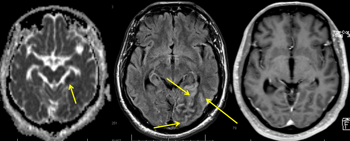 Encephalitis Mri