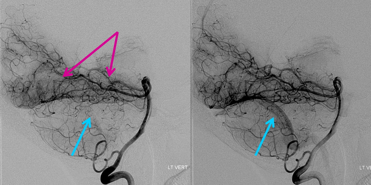 Encephalitis angio lateral