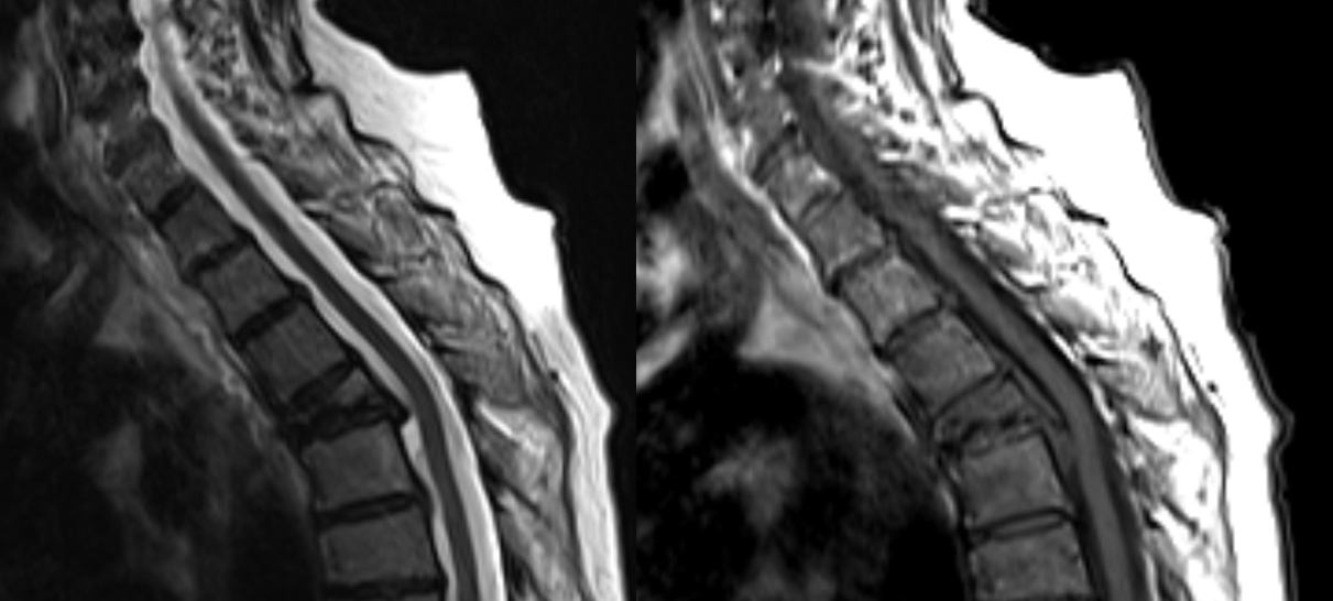 MRI vertebral collapse