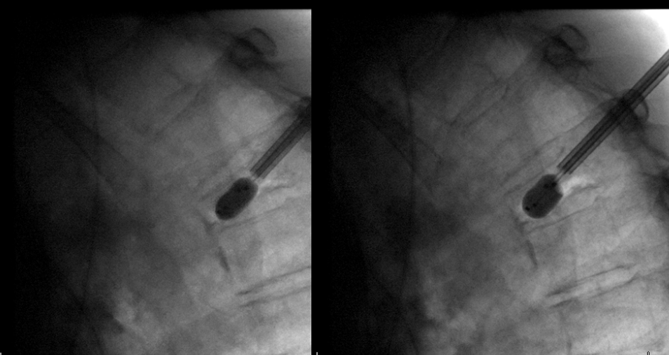 Vertebral collapse kypho