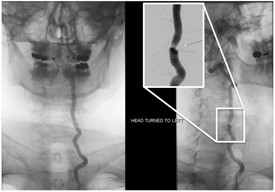 Bow Hunter Syndrome angio frontal views