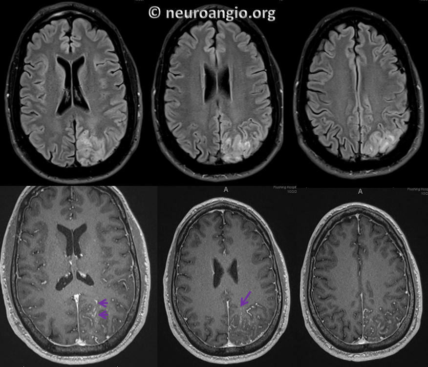 https://neuroangio.org/wp-content/uploads/Archives/Case_Archives_Dural_Fistula_Direct_Drainage_1.png