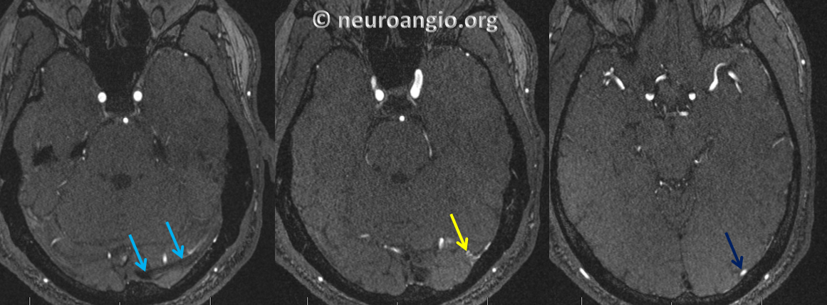 https://neuroangio.org/wp-content/uploads/Archives/Case_Archives_Dural_Fistula_Direct_Drainage_2.png