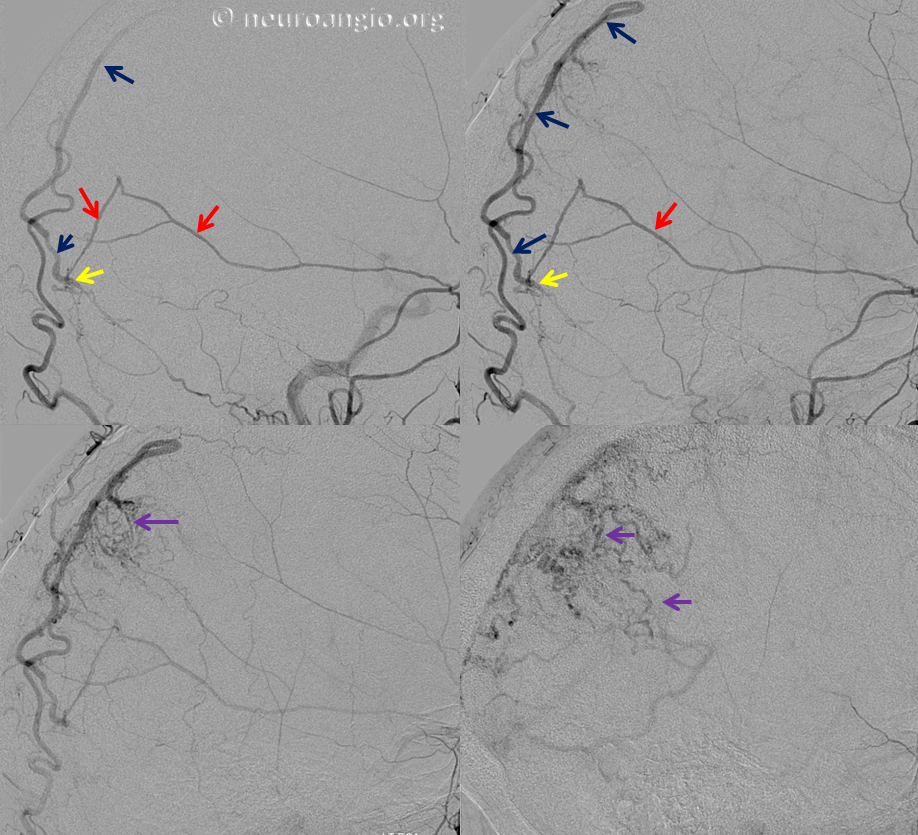 https://neuroangio.org/wp-content/uploads/Archives/Case_Archives_Dural_Fistula_Direct_Drainage_3.png