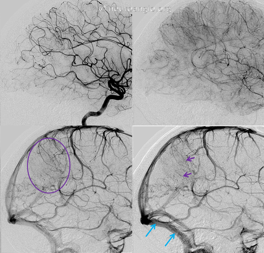 https://neuroangio.org/wp-content/uploads/Archives/Case_Archives_Dural_Fistula_Direct_Drainage_4.png