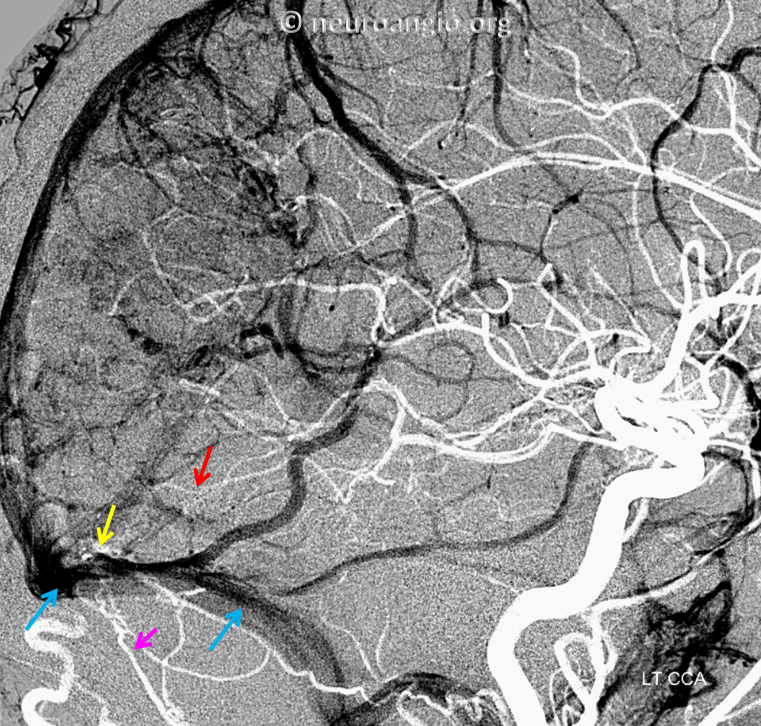 https://neuroangio.org/wp-content/uploads/Archives/Case_Archives_Dural_Fistula_Direct_Drainage_5.png