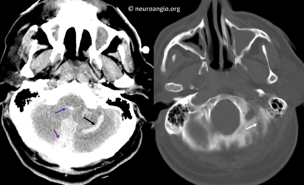 https://neuroangio.org/wp-content/uploads/Archives/Case_Archives_occipital_dural_fistula_1.png