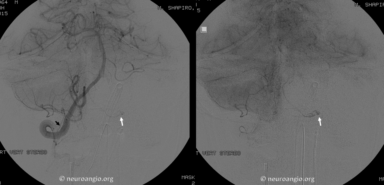 https://neuroangio.org/wp-content/uploads/Archives/Case_Archives_occipital_dural_fistula_2.png