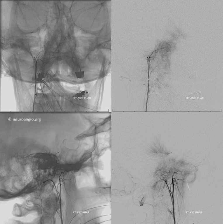 Meningioma embolization