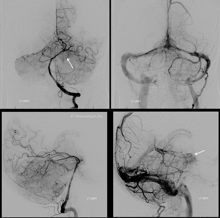 Meningioma embolization