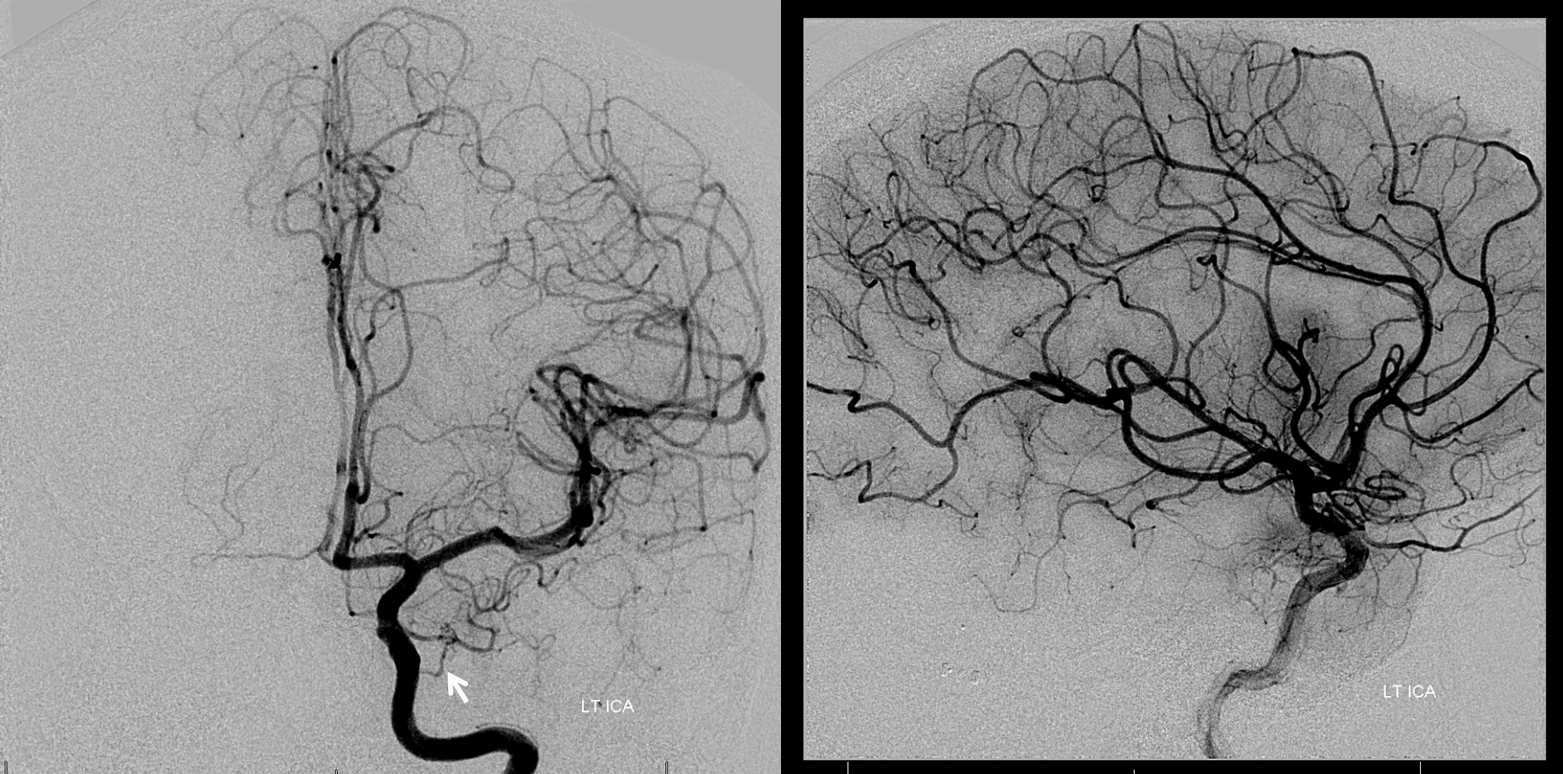 Meningioma embolization