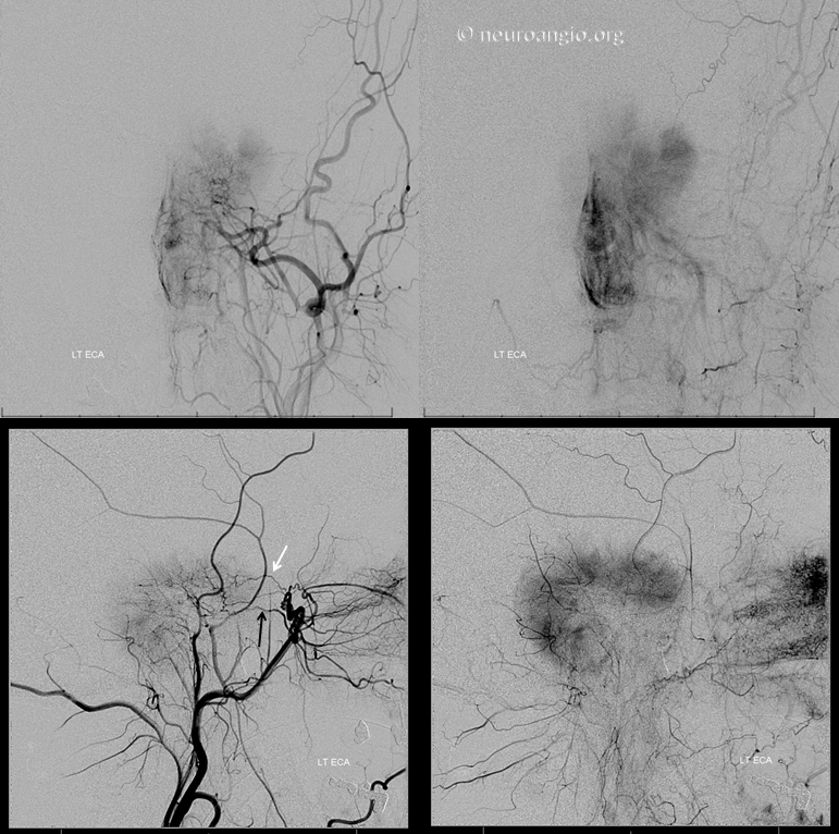 Meningioma embolization