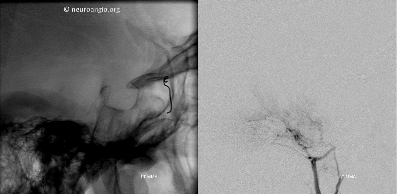 Meningioma embolization