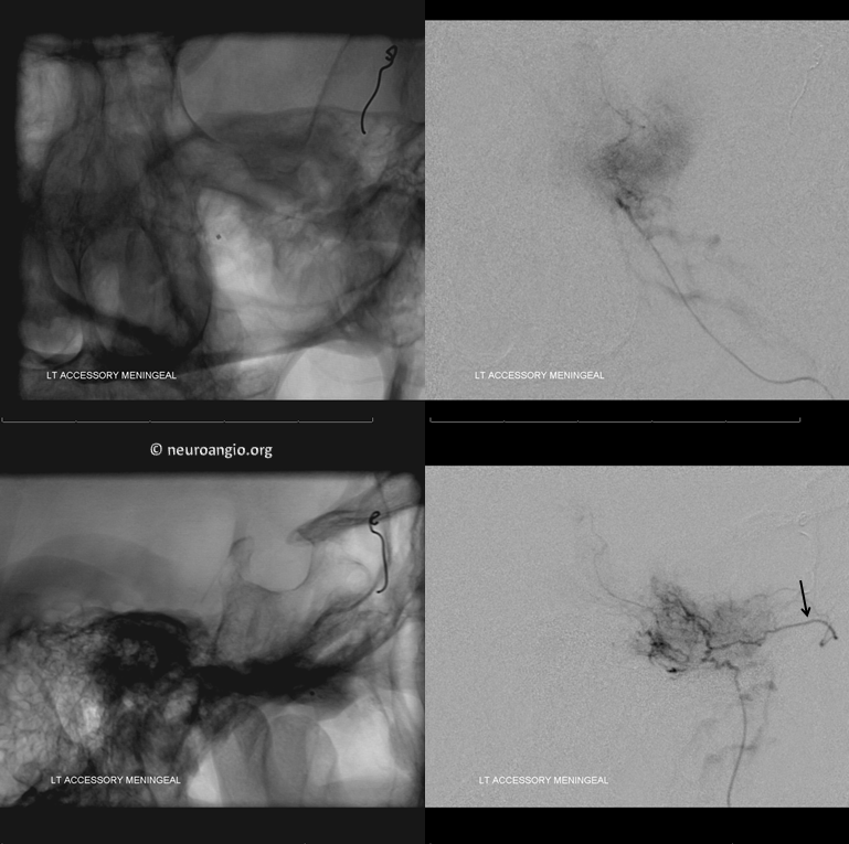 Meningioma embolization