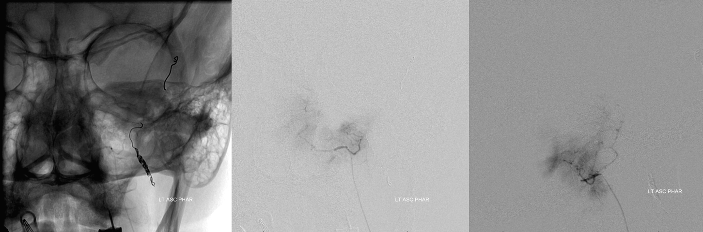 Meningioma embolization