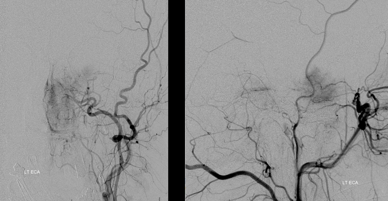 Meningioma embolization